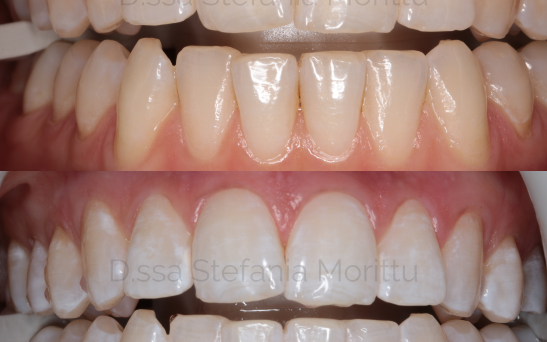 Sbiancamento Dentale Professionale light