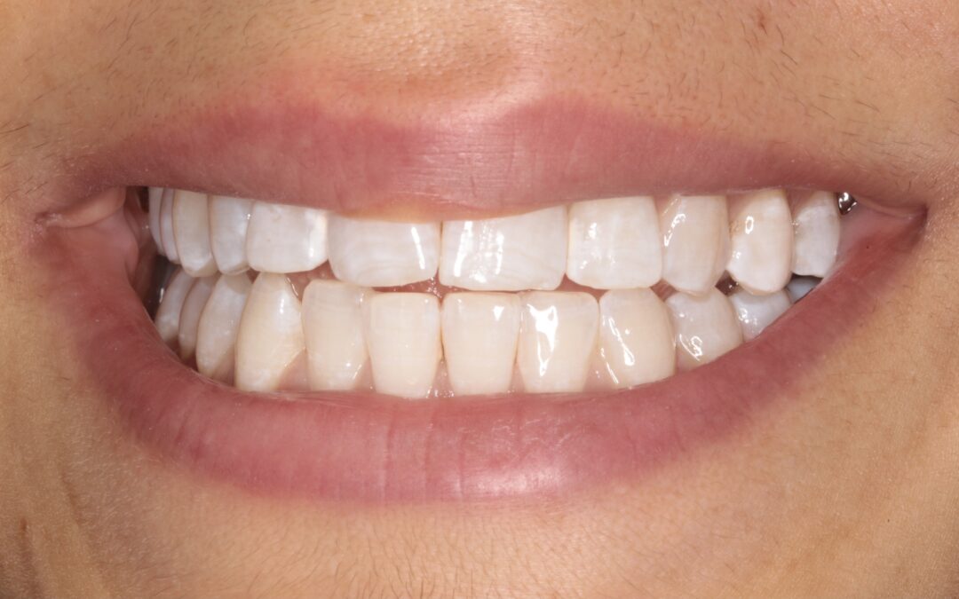 Denti Bianchi